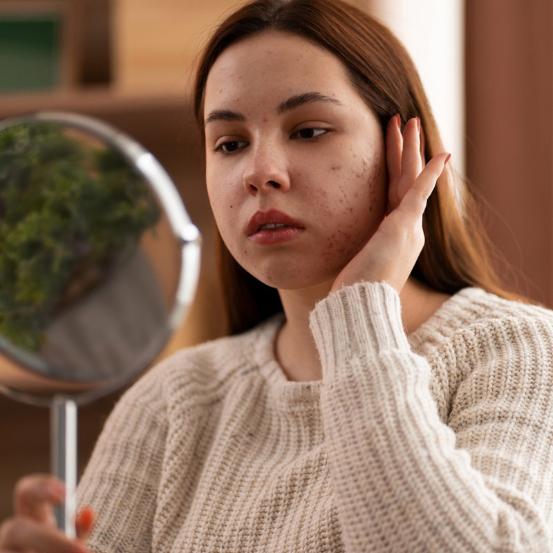 best chemical peels for acne scars