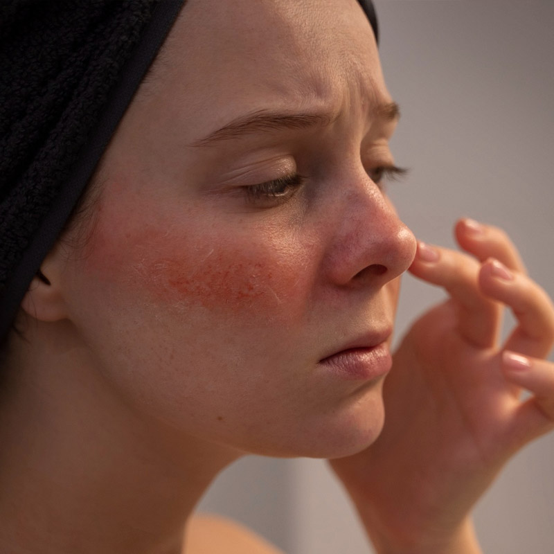best chemical peels for acne scars