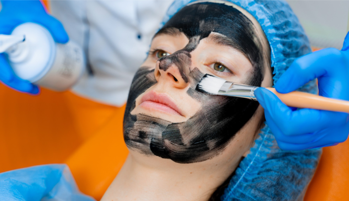  carbon laser peel