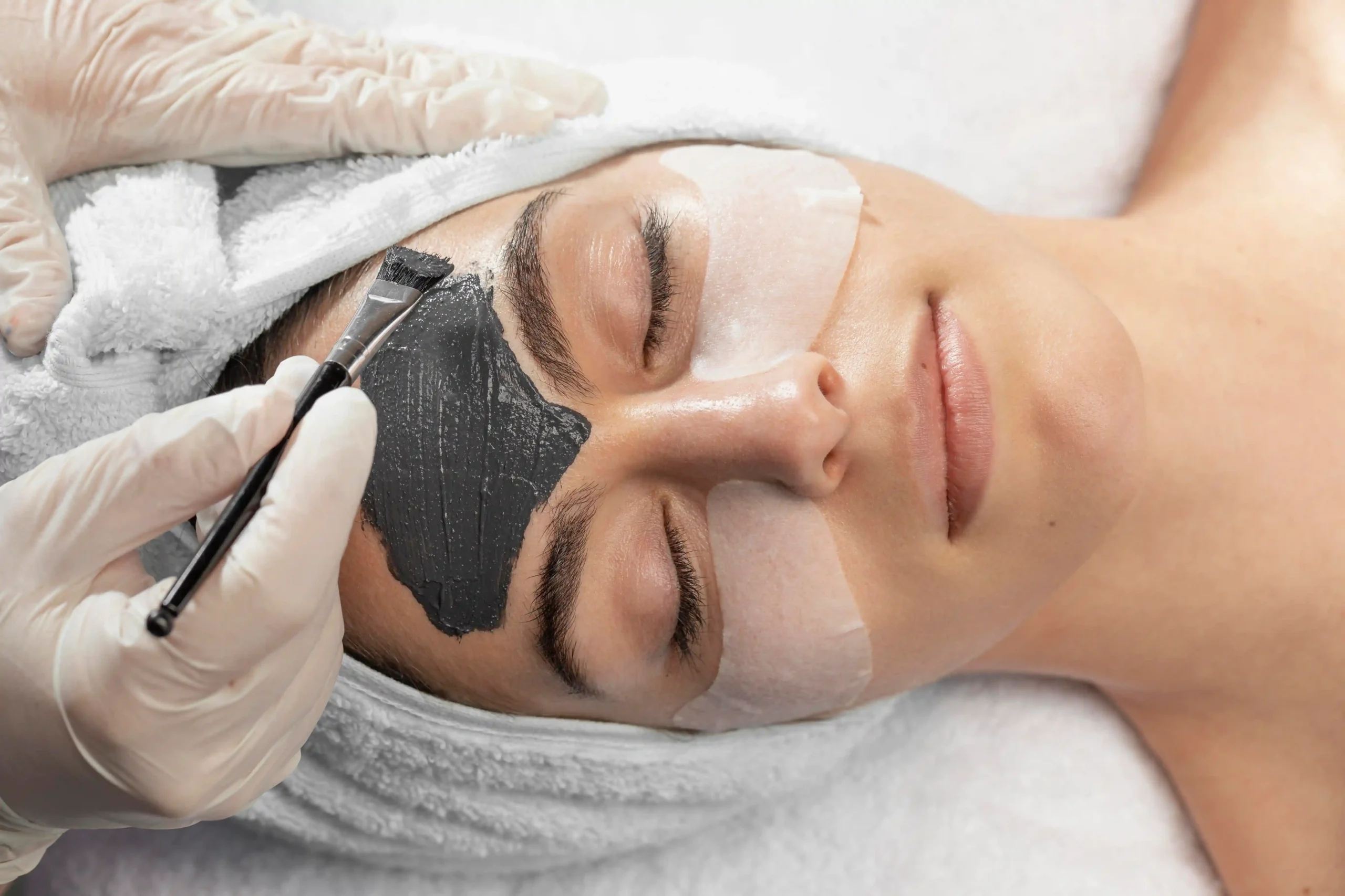 Carbon Laser Peel for Acne in Thrissur